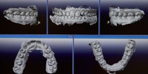 Digital Impression Orthodontic case