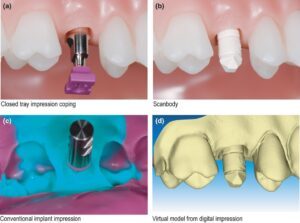 Digital Impression Dental Implant
