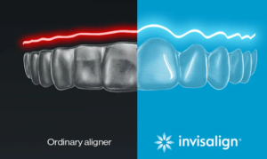 Odinary aligners versus Invisalign clear aligners 