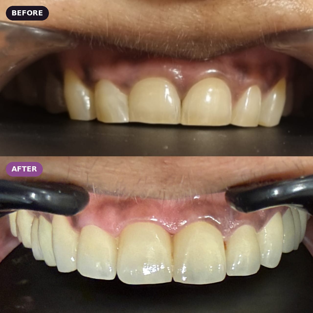 Front teeth restored, before and after