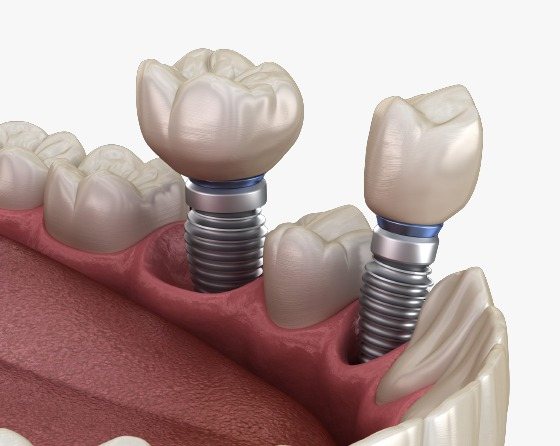 Illustration of a dental implant supporting a crown