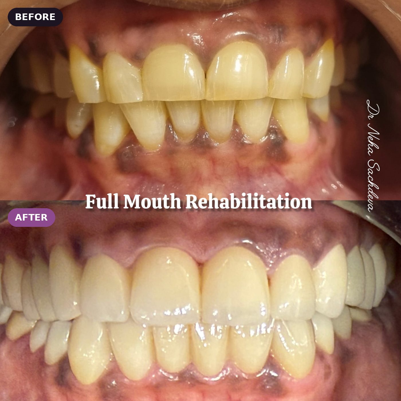 Full mouth rehabilitation, before and after