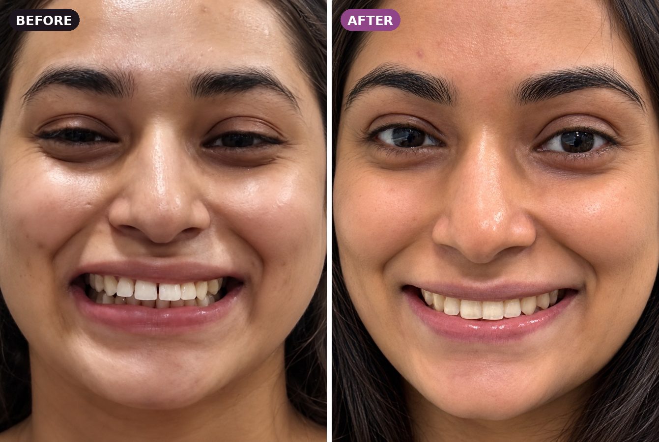 Clear aligner patient, before and after