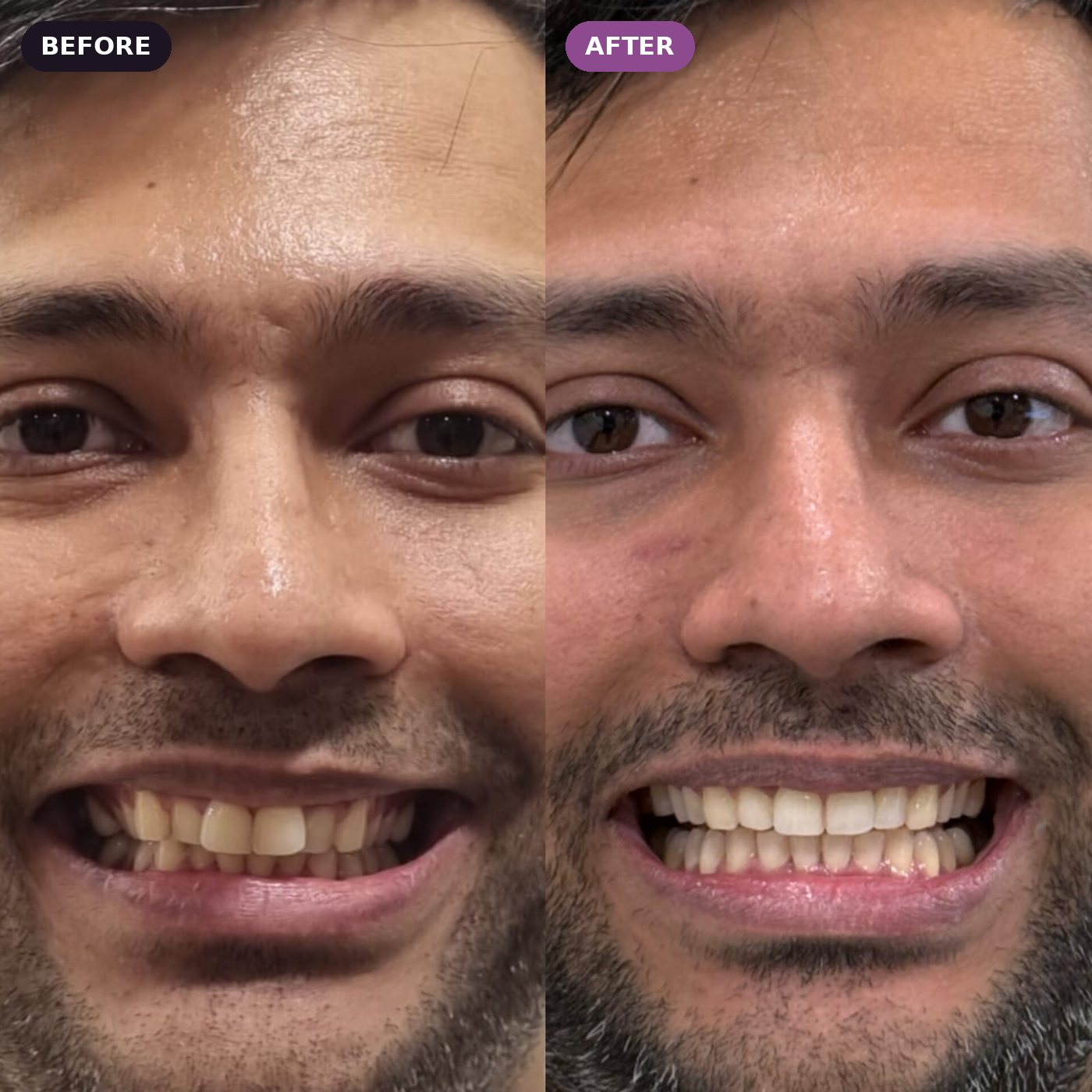 Smile makeover patient, before and after