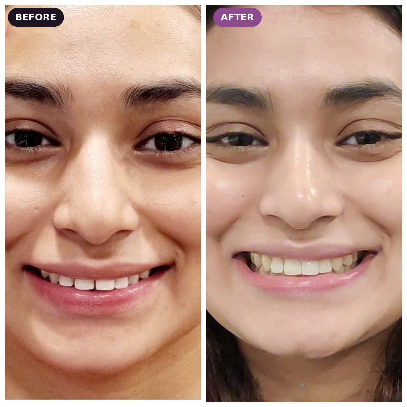 Smile makeover patient, before and after