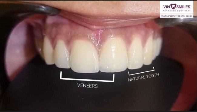 Veneers placed alongside a natural tooth