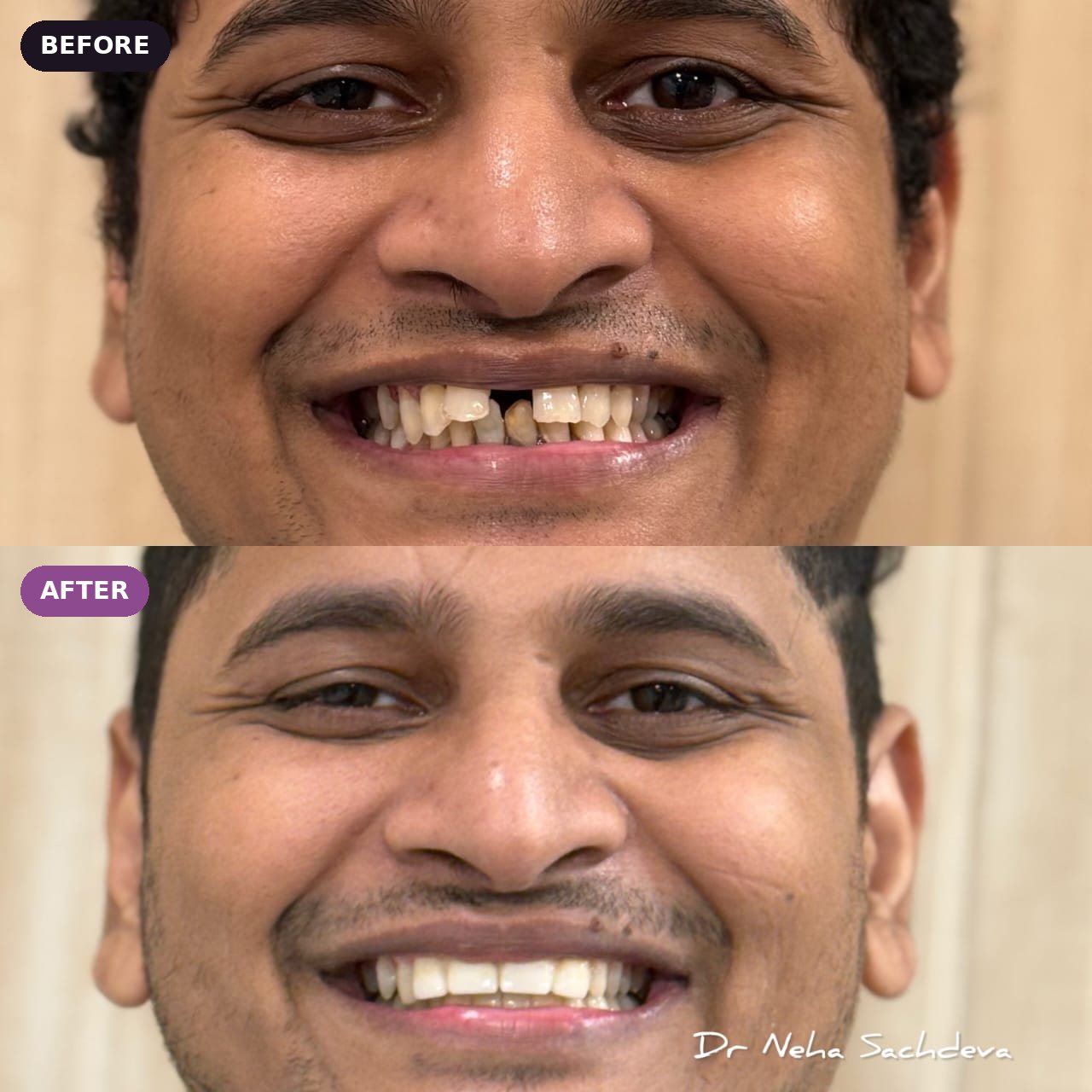 Gap in the front teeth closed, before and after